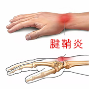 抱孩子抱成腱鞘炎  怎么办？一种方法彻底治疗好