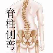 脊柱侧弯自我矫正没有用？  脊柱侧弯专家来教你